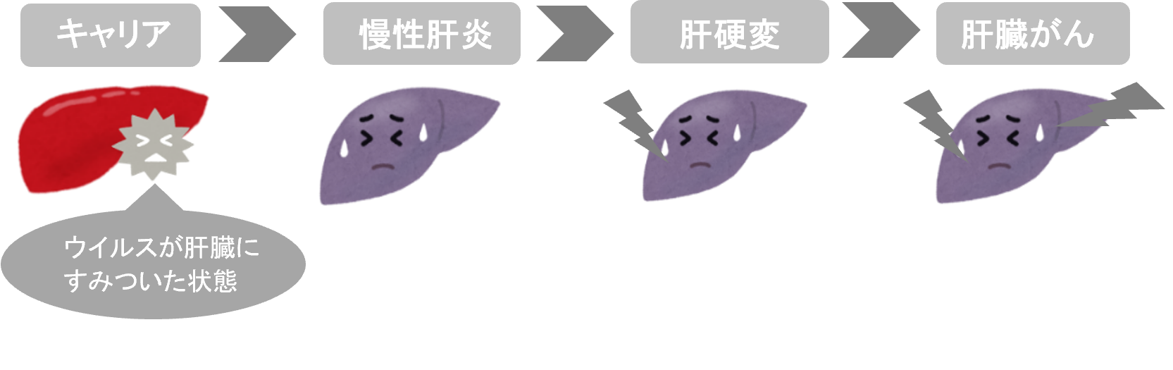 キャリアから慢性肝炎、肝硬変、肝臓がんと進む様子を表したイラスト